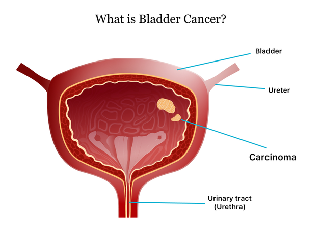 The Connection Between Urinary Tract Infections and Bladder Cancer
